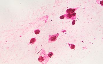 Helicobacter pylori Gram stain