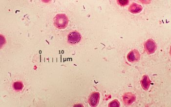 Mycobacterium abscessus Gram stain