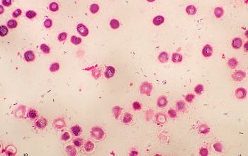 Mycobacterium abscessus Gram stain
