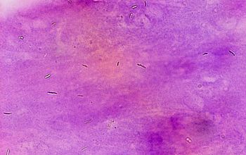 Mycobacterium tuberculosis Gram stain