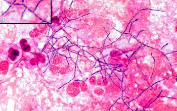 Nocardia astroides Gram stain