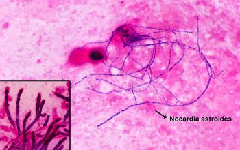 Nocardia otitidiscaviarum Gram stain