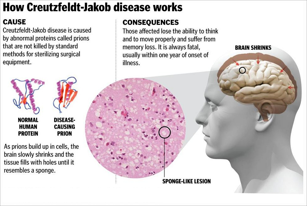 Creutzfeldt-Jakob Disease