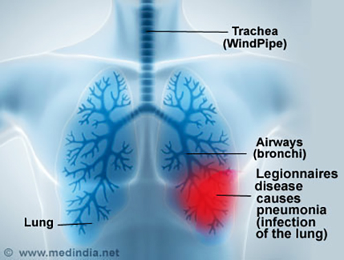 Legionnaires Disease [ 378 x 500 Pixel ]