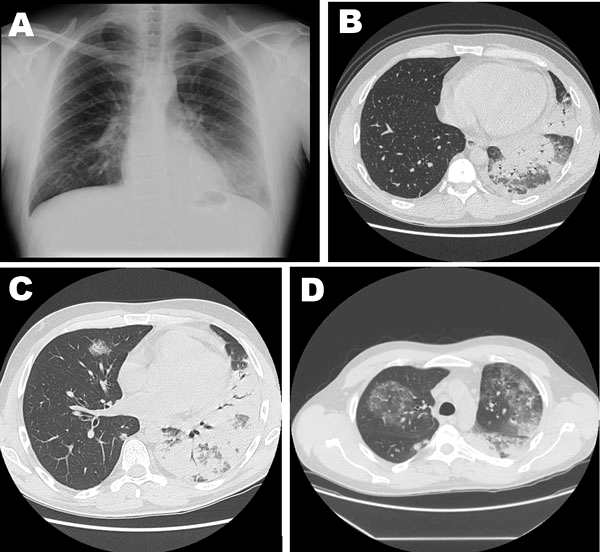 Legionnaires disease